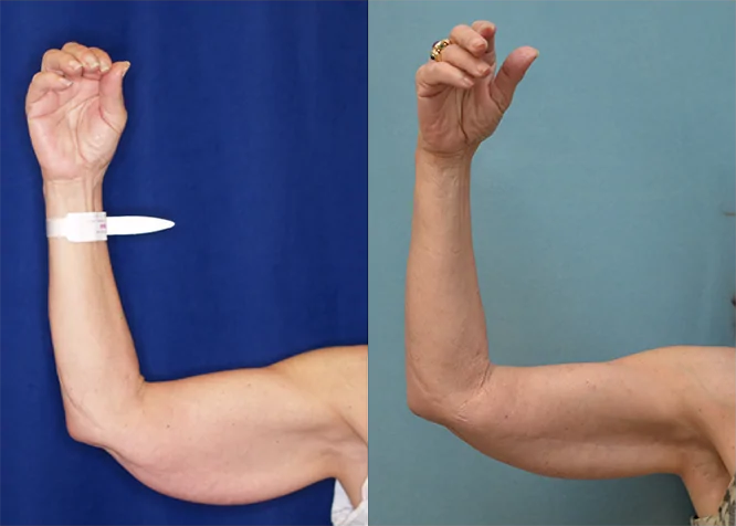 Arm Lift before and after photo by J. Gerald Minniti in Beverly Hills, CA