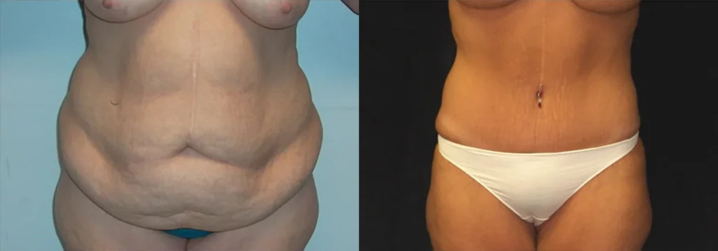 Tummy Tuck before and after photo by J. Gerald Minniti in Beverly Hills, CA