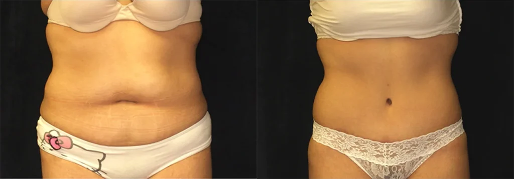 Tummy Tuck before and after photo by J. Gerald Minniti in Beverly Hills, CA