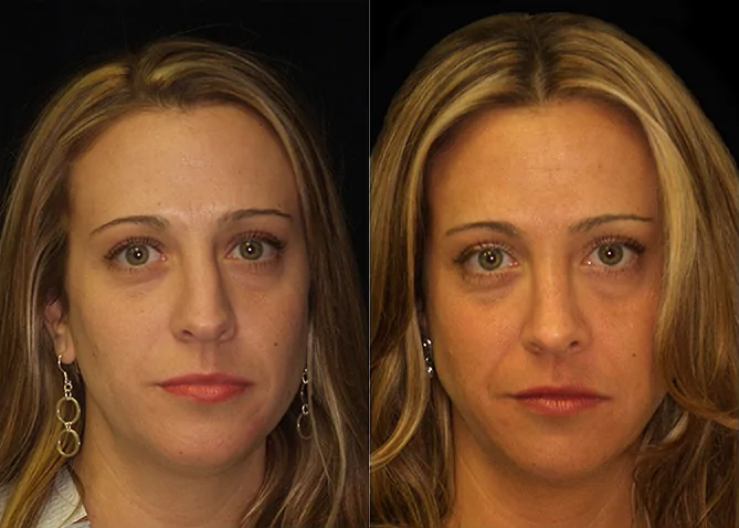 Rhinoplasty before and after photo by J. Gerald Minniti in Beverly Hills, CA