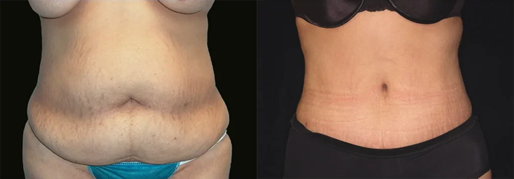 Tummy Tuck before and after photo by J. Gerald Minniti in Beverly Hills, CA