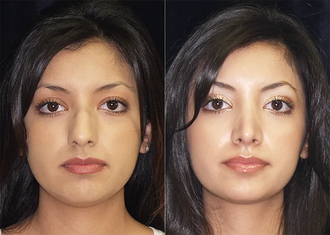 Rhinoplasty before and after photo by J. Gerald Minniti in Beverly Hills, CA