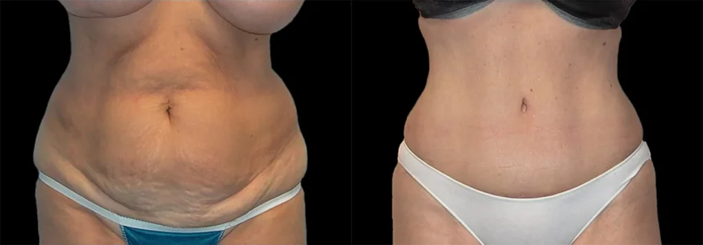 Tummy Tuck before and after photo by J. Gerald Minniti in Beverly Hills, CA