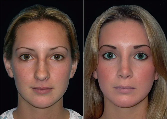 Rhinoplasty before and after photo by J. Gerald Minniti in Beverly Hills, CA