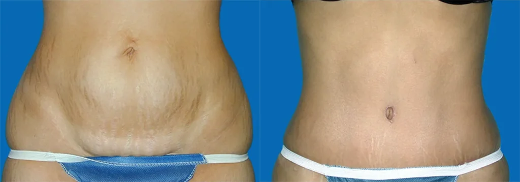 Tummy Tuck before and after photo by J. Gerald Minniti in Beverly Hills, CA