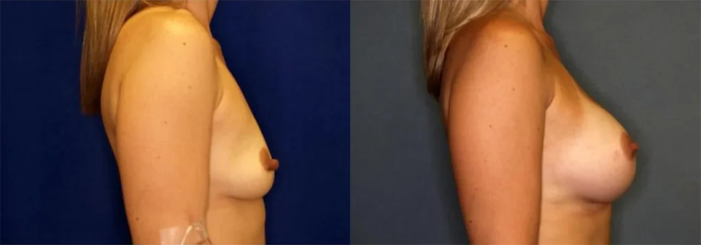 Breast Augmentation before and after photo by J. Gerald Minniti in Beverly Hills, CA