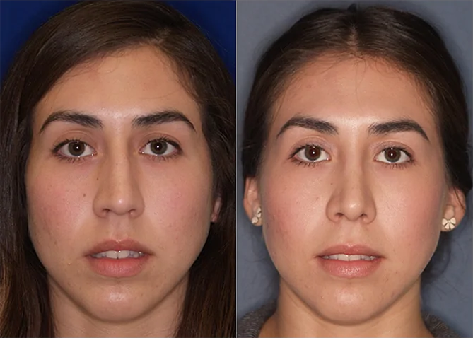 Rhinoplasty before and after photo by J. Gerald Minniti in Beverly Hills, CA
