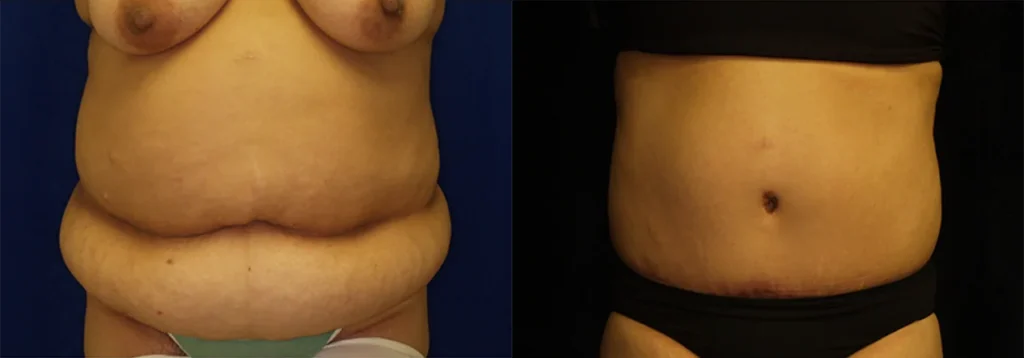 Tummy Tuck before and after photo by J. Gerald Minniti in Beverly Hills, CA