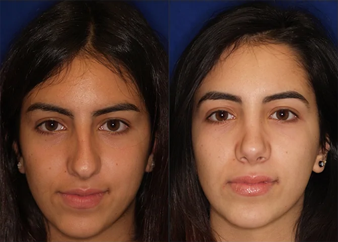 Rhinoplasty before and after photo by J. Gerald Minniti in Beverly Hills, CA