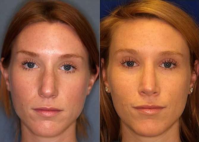 Rhinoplasty before and after photo by J. Gerald Minniti in Beverly Hills, CA