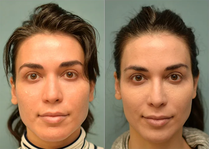 Rhinoplasty before and after photo by J. Gerald Minniti in Beverly Hills, CA