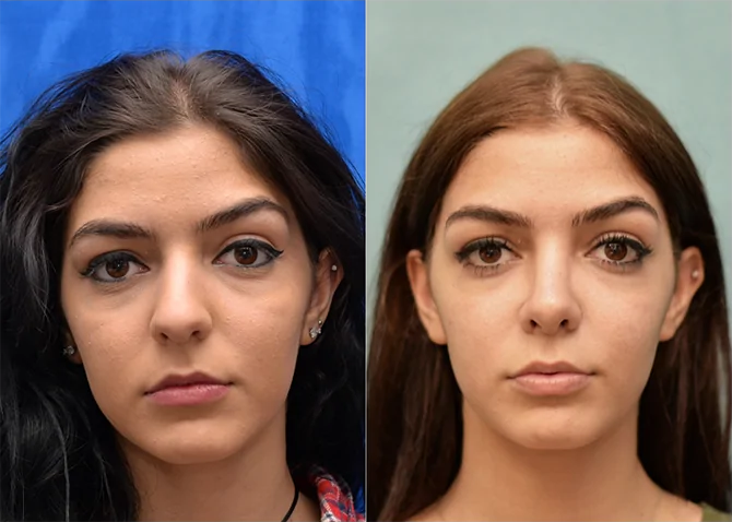 Rhinoplasty before and after photo by J. Gerald Minniti in Beverly Hills, CA