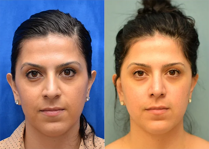 Rhinoplasty before and after photo by J. Gerald Minniti in Beverly Hills, CA