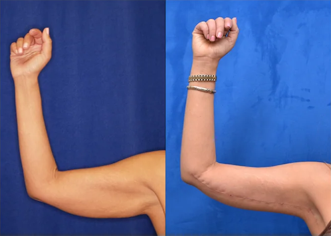 Arm Lift before and after photo by J. Gerald Minniti in Beverly Hills, CA
