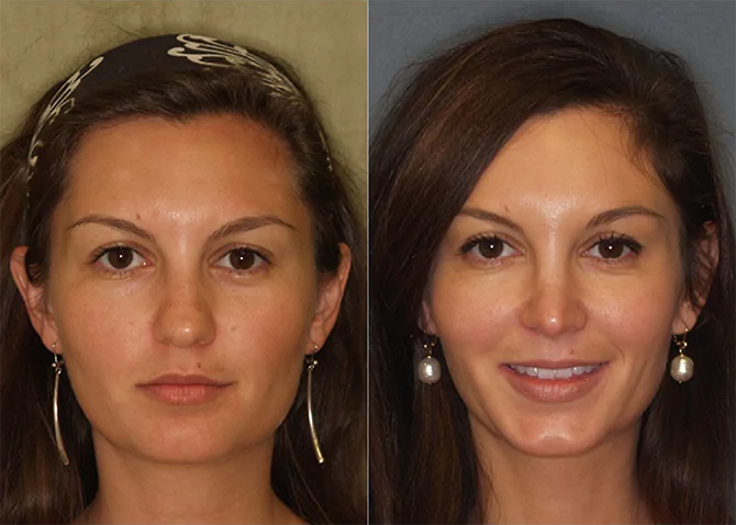 Rhinoplasty before and after photo by J. Gerald Minniti in Beverly Hills, CA
