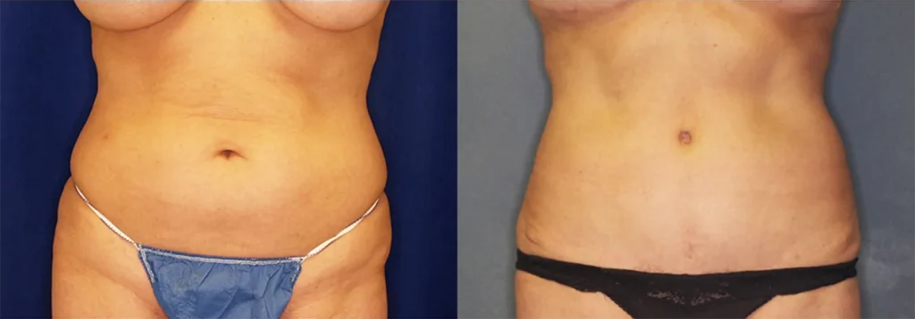 Tummy Tuck before and after photo by J. Gerald Minniti in Beverly Hills, CA