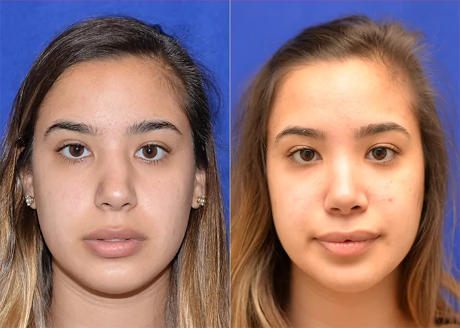 Rhinoplasty before and after photo by J. Gerald Minniti in Beverly Hills, CA