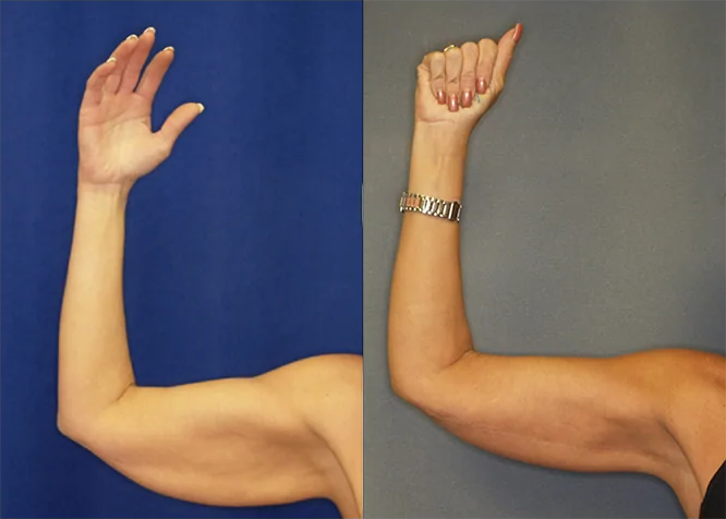 Arm Lift before and after photo by J. Gerald Minniti in Beverly Hills, CA