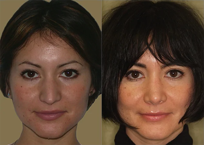 Rhinoplasty before and after photo by J. Gerald Minniti in Beverly Hills, CA