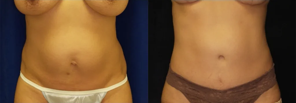 Tummy Tuck before and after photo by J. Gerald Minniti in Beverly Hills, CA