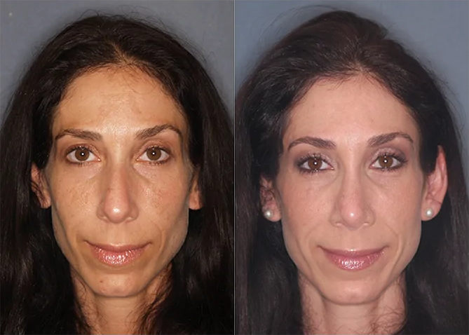 Rhinoplasty before and after photo by J. Gerald Minniti in Beverly Hills, CA