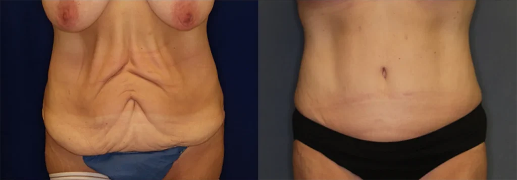 Tummy Tuck before and after photo by J. Gerald Minniti in Beverly Hills, CA
