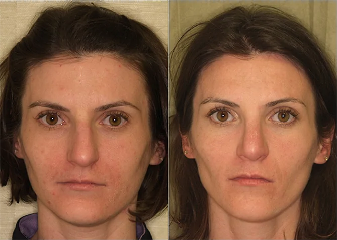 Rhinoplasty before and after photo by J. Gerald Minniti in Beverly Hills, CA
