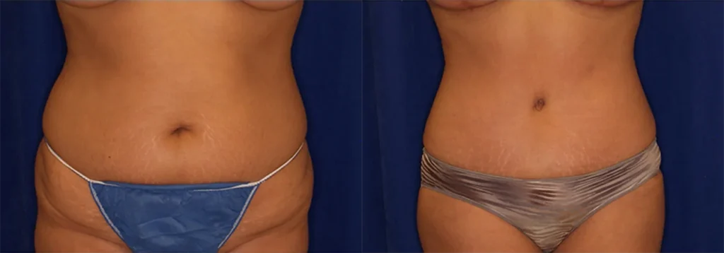 Tummy Tuck before and after photo by J. Gerald Minniti in Beverly Hills, CA