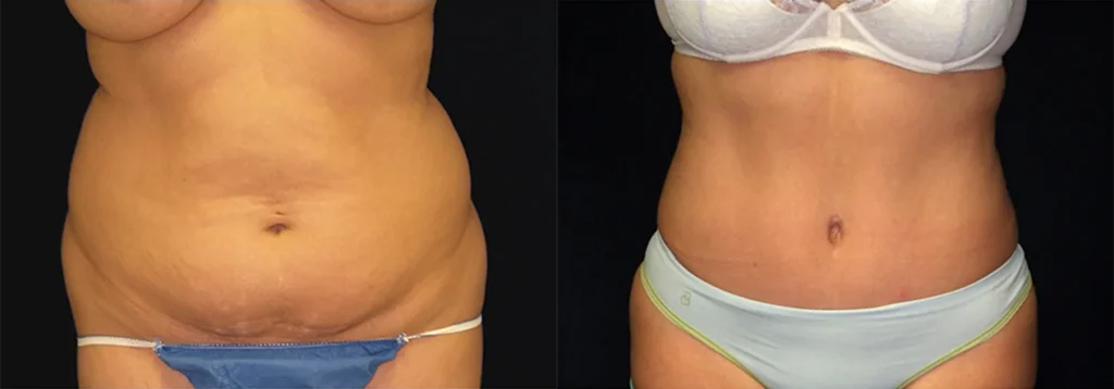 Tummy Tuck before and after photo by J. Gerald Minniti in Beverly Hills, CA