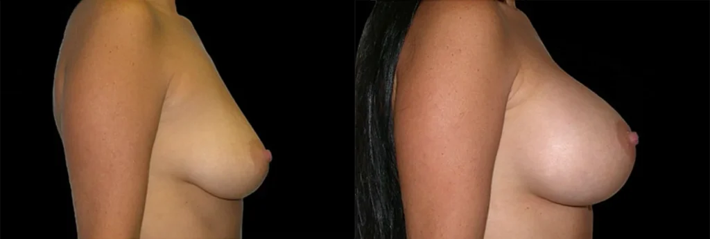 Breast Augmentation before and after photo by J. Gerald Minniti in Beverly Hills, CA