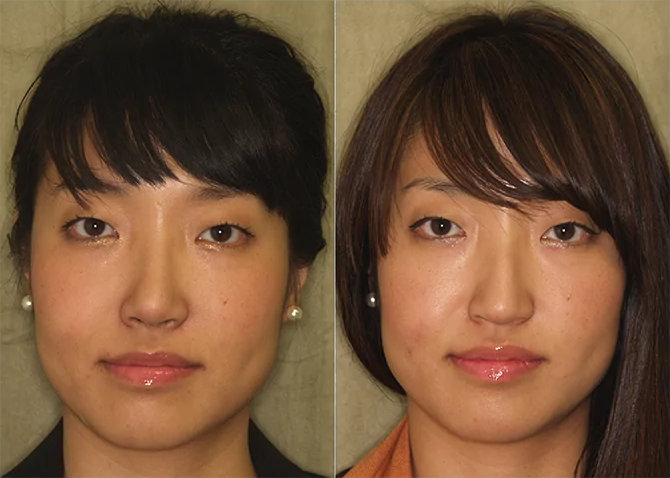 Rhinoplasty before and after photo by J. Gerald Minniti in Beverly Hills, CA