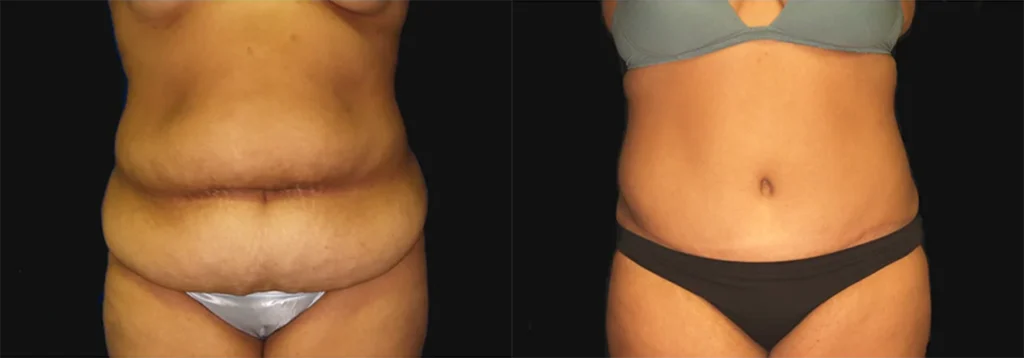 Tummy Tuck before and after photo by J. Gerald Minniti in Beverly Hills, CA