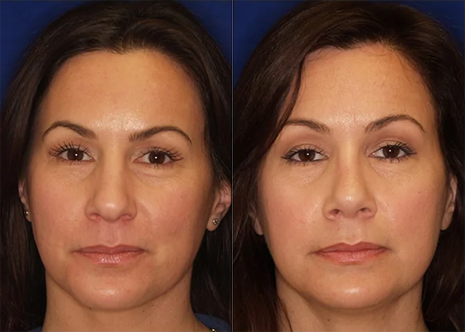 Rhinoplasty before and after photo by J. Gerald Minniti in Beverly Hills, CA