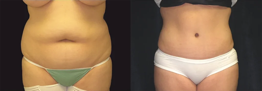 Tummy Tuck before and after photo by J. Gerald Minniti in Beverly Hills, CA
