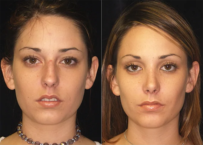 Rhinoplasty before and after photo by J. Gerald Minniti in Beverly Hills, CA