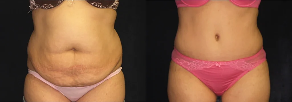 Tummy Tuck before and after photo by J. Gerald Minniti in Beverly Hills, CA