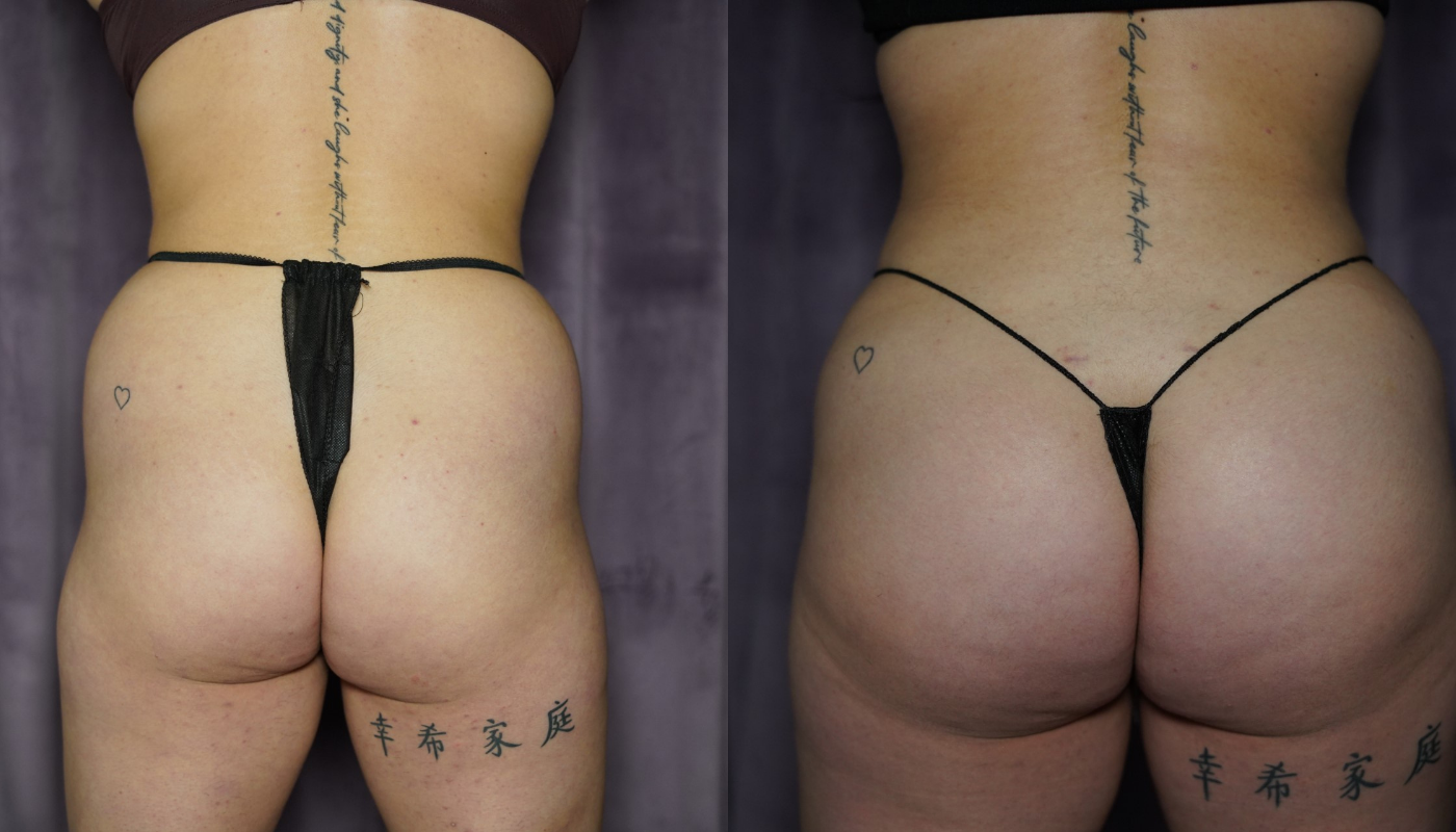 BBL before and after results BBL before and after results