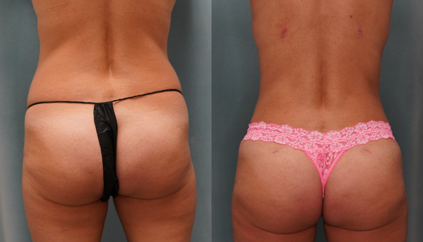 BBL before and after results BBL before and after results