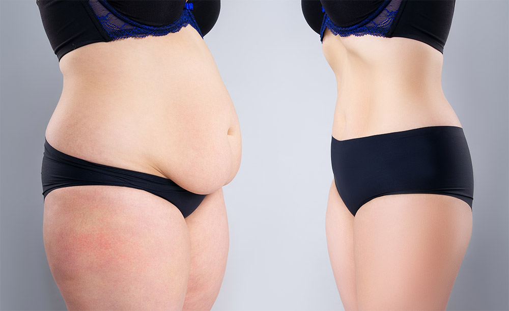 Woman's belly before and after weight loss on gray background