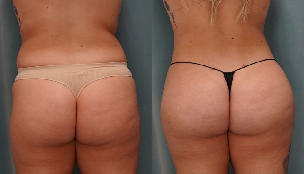 bbl before and after photo by j gerald minniti in beverly hills ca