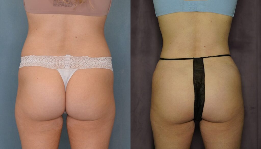 bbl before and after photo by j gerald minniti in beverly hills ca
