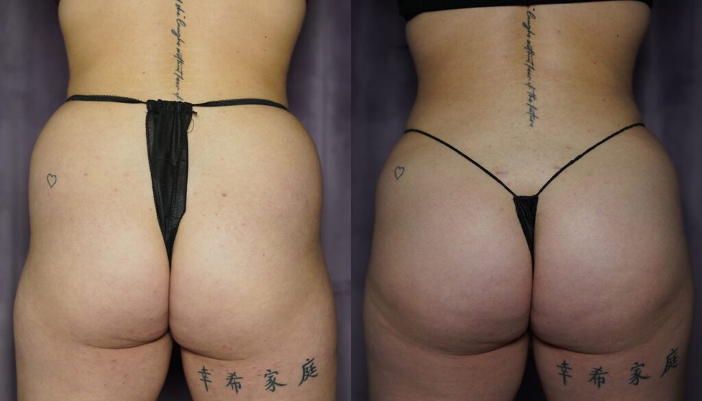 bbl before and after photo by j gerald minniti in beverly hills ca