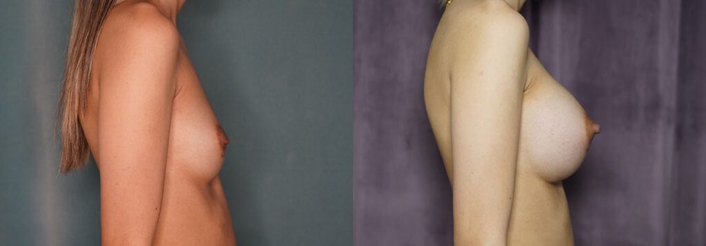breast augmentation before and after photo by j gerald minniti in beverly hills ca