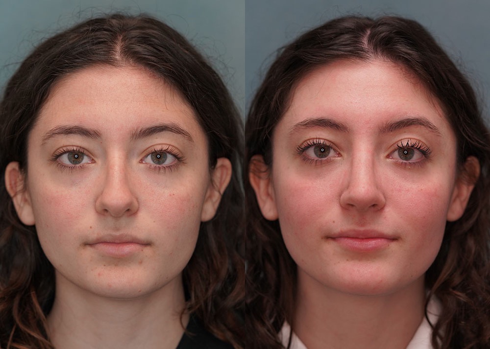 rhinoplasty before and after photo by j gerald minniti in beverly hills ca