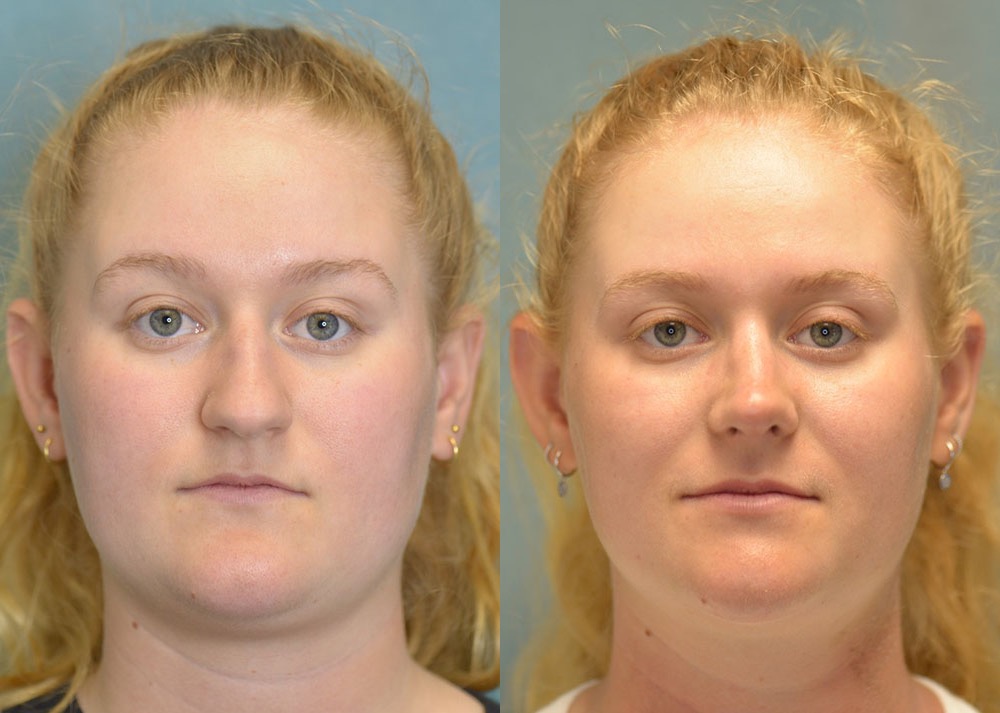 rhinoplasty before and after photo by j gerald minniti in beverly hills ca