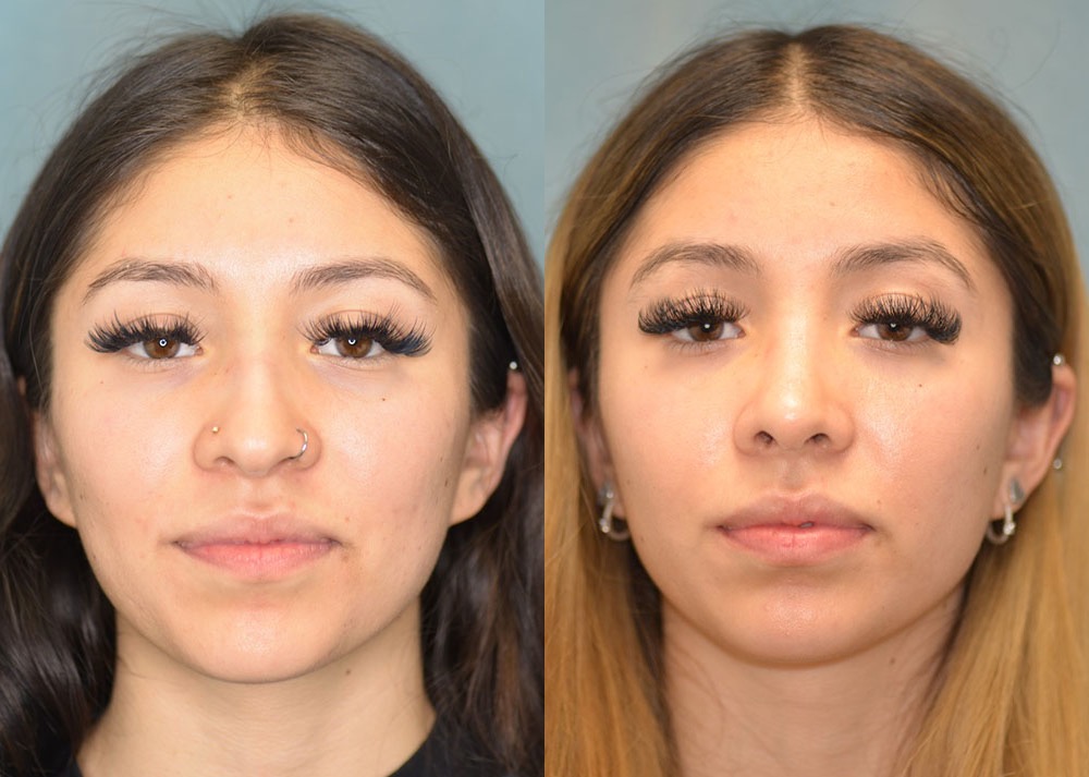 rhinoplasty before and after photo by j gerald minniti in beverly hills ca