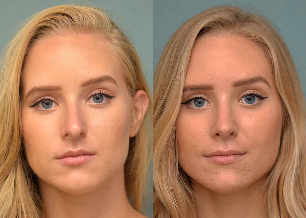 rhinoplasty before and after photo by j gerald minniti in beverly hills ca