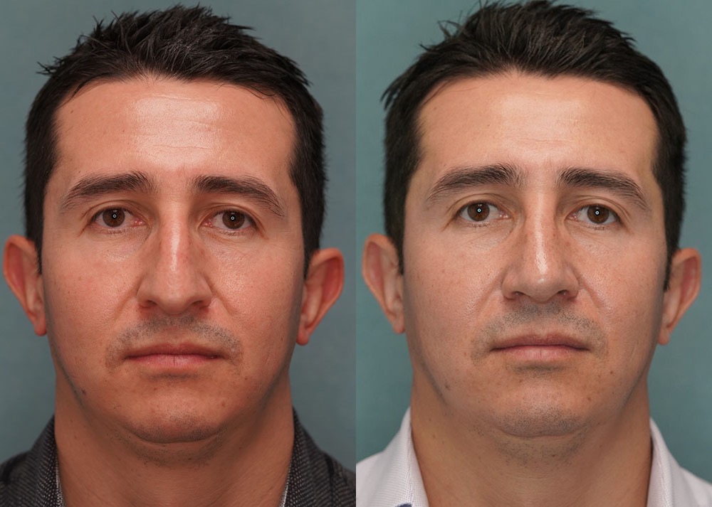 rhinoplasty before and after photo by j gerald minniti in beverly hills ca