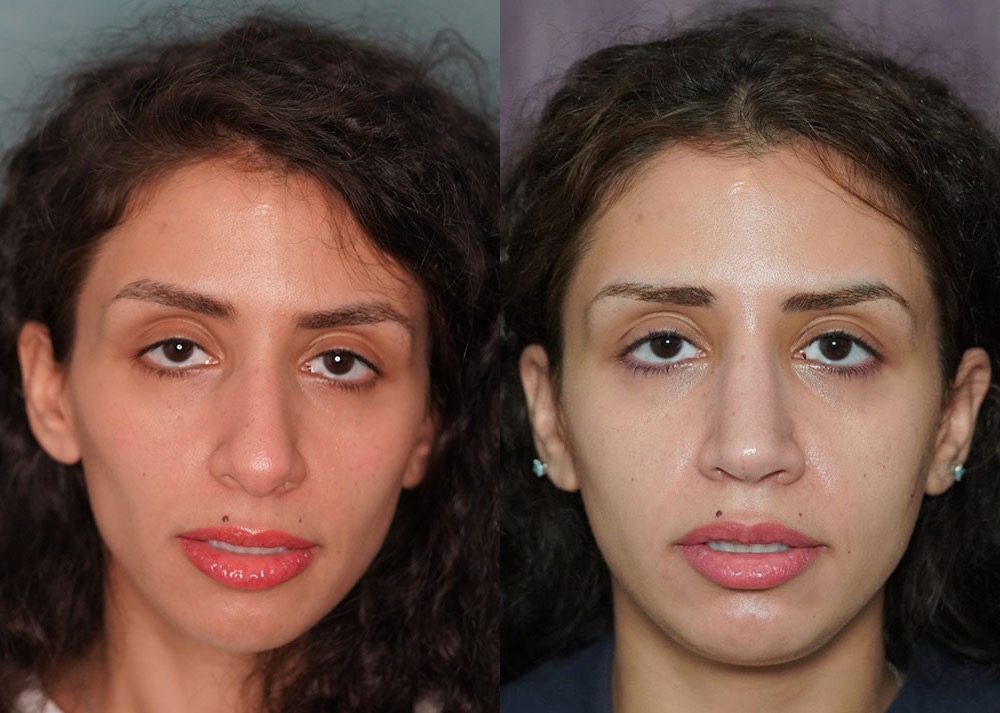 rhinoplasty before and after photo by j gerald minniti in beverly hills ca
