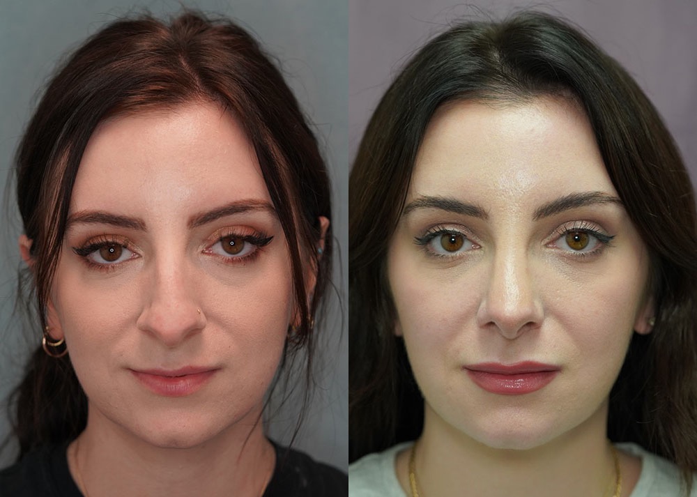 rhinoplasty before and after photo by j gerald minniti in beverly hills ca